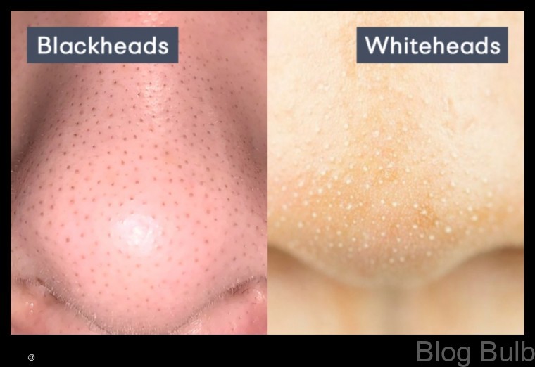 %name Blackheads vs Whiteheads Whats the Difference